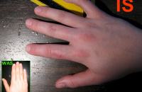 Артрит кисти рук: лечение
